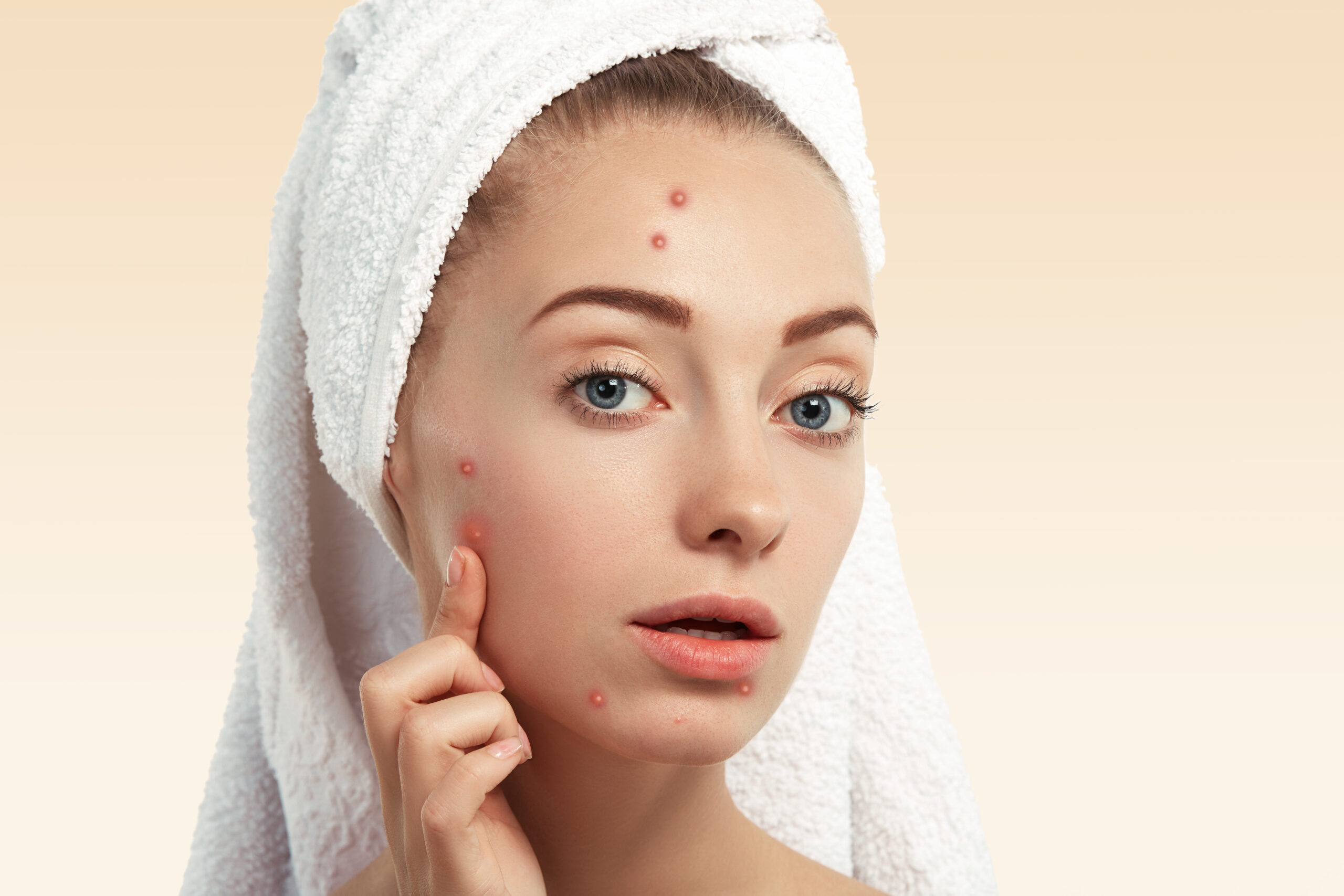 Best Acne Scar Treatment in Mohali