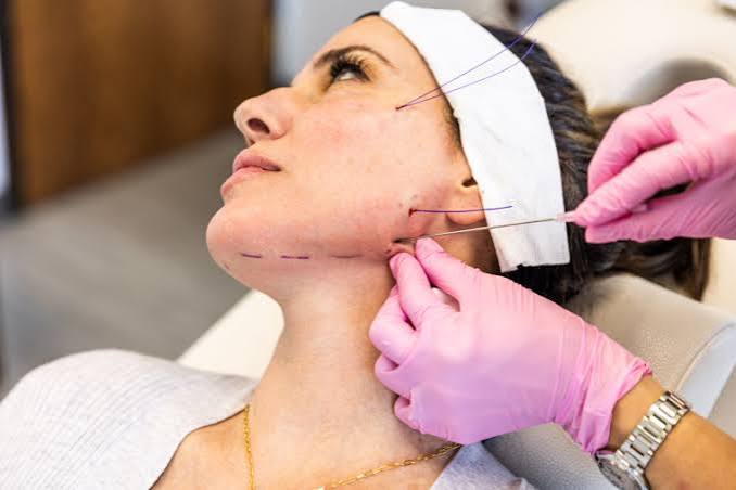 Thread Lift Treatment in Mohali