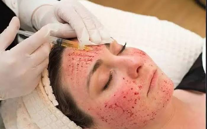 Vampire Facial in Mohali
