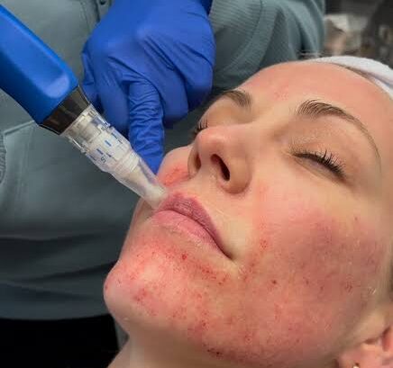 Microneedling Treatment in Mohali